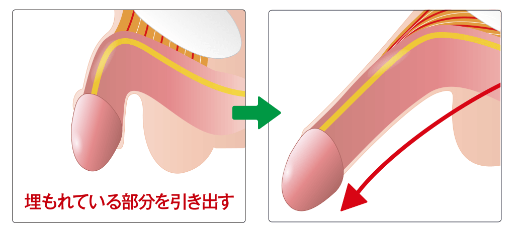 埋もれている陰茎を引き出す切らない長茎術