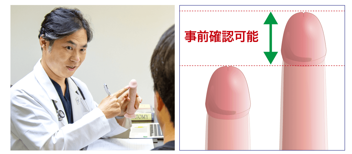 長茎術の無料診察カウンセリング