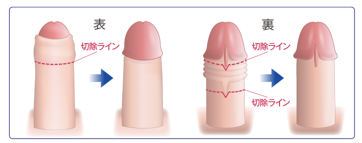 WVカット包茎手術