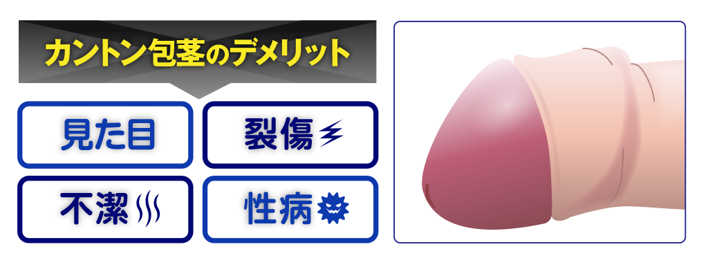 カントン包茎のデメリット
